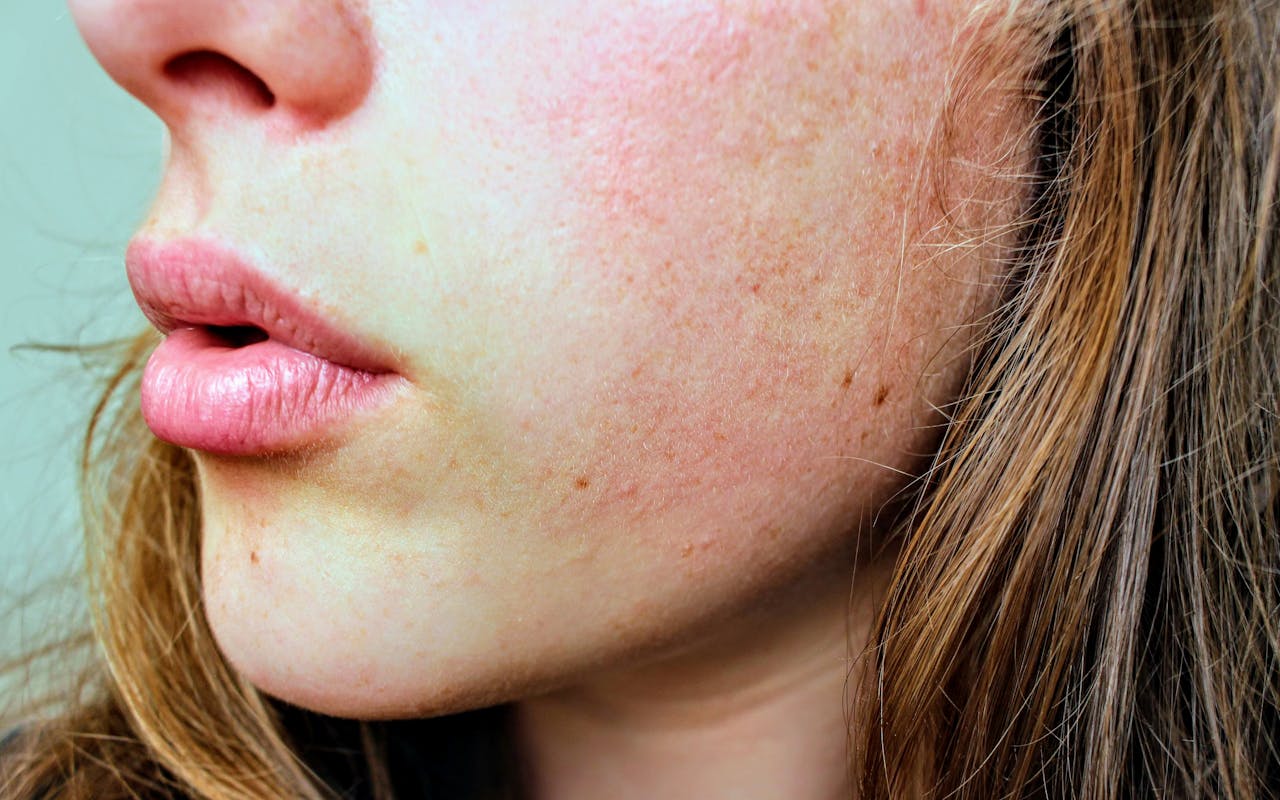 Woman looking at acne breakout on her face after starting hormonal contraception